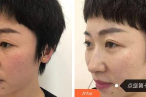 包頭麗人婦產(chǎn)醫(yī)院醫(yī)學(xué)美容科孫武堅整形價格表附去痘印痘坑例展示