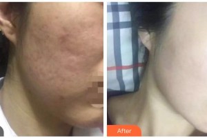 包頭中心醫(yī)院燒傷整形美容科姚炎燚整形價(jià)格表附微針美膚案例展示