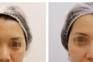 包頭葉子整形美容醫(yī)院閆侯旺整形價(jià)格表附光子嫩膚案例展示