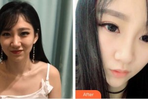 包頭華美醫(yī)療美容醫(yī)院潘在常整形價(jià)格表附鼻部綜合案例展示