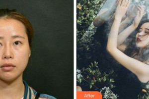 包頭李德皮膚醫(yī)院李德整形價格表附鼻翼縮小案例展示