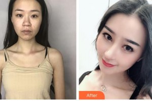 包頭李德皮膚醫(yī)院于習(xí)軍整形價(jià)格表附鼻部綜合案例展示