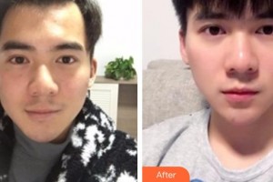 包頭李德皮膚醫(yī)院謝志強(qiáng)整形價(jià)格表附白瓷娃娃案例展示