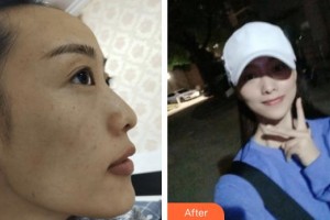 包頭聯(lián)合麗格醫(yī)療美容門診部崔曉穎整形價格表附激光祛斑案例展示