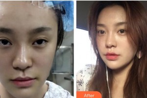 包頭聯(lián)合麗格醫(yī)療美容門診部董曉宏整形價格表附埋線提升案例展示