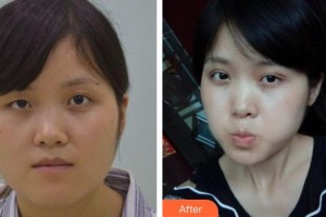 包頭朝聚眼科醫(yī)院張小利整形價(jià)格表附切開雙眼皮案例展示