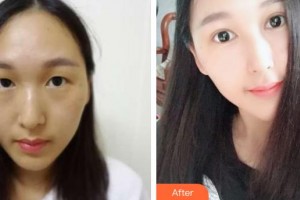 包頭朝聚眼科醫(yī)院邊小燕整形價(jià)格表附切開雙眼皮案例展示