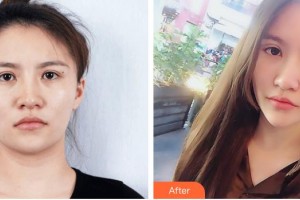 包頭麗人婦產(chǎn)醫(yī)院醫(yī)學(xué)美容科李繼偉整形價(jià)格表附埋線雙眼皮案例展示