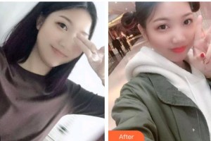 包頭朝聚眼科醫(yī)院周園整形價(jià)格表附眼部綜合例展示