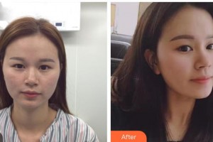 包頭朝聚眼科醫(yī)院孔新萍整形價(jià)格表附切開雙眼皮案例展示