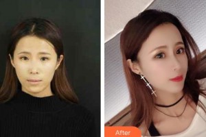 烏海市人民醫(yī)院整形外科馬語遙整形價(jià)格表附耳軟骨復(fù)合隆鼻案例展示