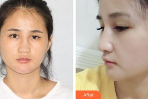 烏海市人民醫(yī)院整形外科趙軍委整形價(jià)格表附鼻部綜合案例展示