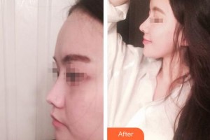 赤峰現(xiàn)代婦產(chǎn)醫(yī)院醫(yī)療美容科趙宏偉整形價(jià)格表附鼻部綜合例展示