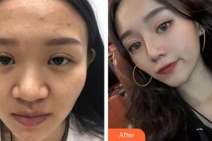 赤峰現(xiàn)代婦產(chǎn)醫(yī)院醫(yī)療美容科袁俊龍整形價(jià)格表附鼻部綜合案例展示