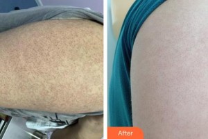 赤峰現(xiàn)代婦產(chǎn)醫(yī)院醫(yī)療美容科肖璇整形價(jià)格表附清潔祛痘案例展示