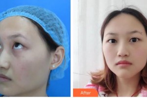 赤峰朝聚眼科醫(yī)院翟長(zhǎng)斌整形價(jià)格表附切開雙眼皮案例展示