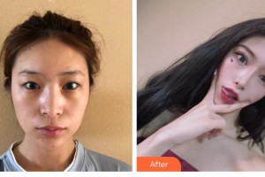 赤峰張安鳳醫(yī)療美容醫(yī)院張安鳳整形價(jià)格表附眼部綜合案例展示