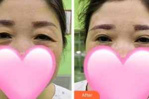 通遼張大夫醫(yī)療美容診所張杰整形價(jià)格表附切眉術(shù)案例展示