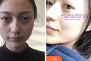 鄂爾多斯百達(dá)麗整形美容醫(yī)院張琳琳整形價(jià)格表附激光點(diǎn)痣案例展示