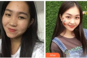 鄂爾多斯市中心醫(yī)院燒傷整形科郭勝利整形價(jià)格表附激光祛斑案例展示