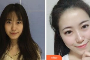 鄂爾多斯天王醫(yī)學(xué)美容醫(yī)院梁曉健整形價格表附無針?biāo)獍咐故?>
</a>
<h3 class=