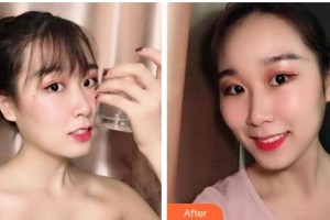 鄂爾多斯口腔醫(yī)院王曉霞整形價格表附牙齒隱形矯正案例展示