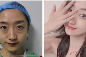 烏蘭察布美尚美醫(yī)學(xué)美容整形醫(yī)院張淼整形價格表附激光去眼袋案例展示