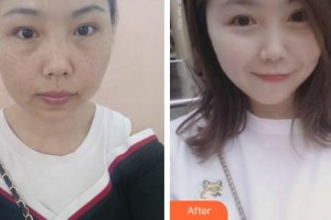 吉林銘醫(yī)整形美容醫(yī)院王丹丹整形價格表附激光祛斑案例展示