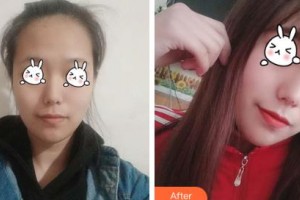 吉林大學第一醫(yī)院整形美容科林泉整形價格表附光子嫩膚案例展示