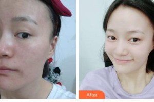 吉林國健整形美容醫(yī)院錢剛整形價格表附去痘印痘坑案例展示