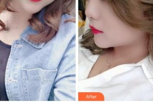 吉林大學第一醫(yī)院整形美容科金洪娟整形價格表附激光祛斑案例展示