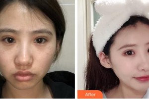 吉林國健整形美容醫(yī)院柳濟圣整形價格表附激光祛斑案例展示