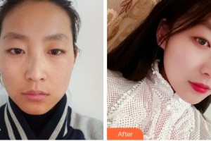 吉林大學第一醫(yī)院整形美容科榮莉整形價格表附光子嫩膚案例展示