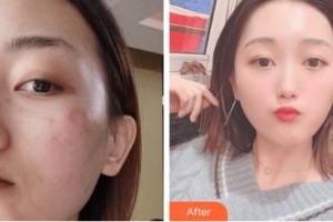 吉林瑞澳醫(yī)學美容醫(yī)院魏軍劍整形價格表附激光祛斑案例展示