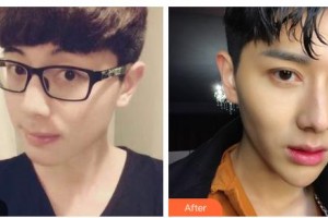 吉林吳麗娟醫(yī)療美容診所吳麗娟整形價格表附眼部綜合案例展示