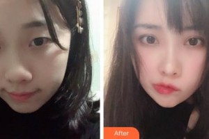 吉林大學中日聯(lián)誼醫(yī)院燒傷整形外科林駐煥整形價格表附眼部綜合案例展示