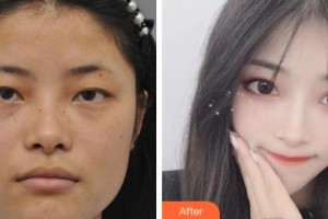 吉林省人民醫(yī)院燒傷整形科劉進輝整形價格表附眼部綜合案例展示