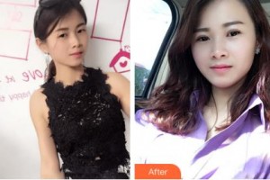 吉林大學中日聯(lián)誼醫(yī)院燒傷整形外科王之清整形價格表附切開雙眼皮案例展示