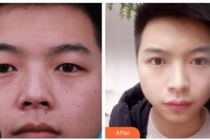 吉林瑞澳醫(yī)學美容醫(yī)院井明整形價格表附切開雙眼皮案例展示