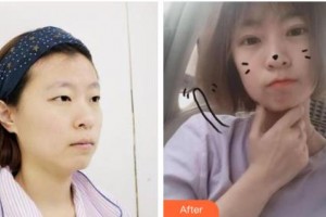 長(zhǎng)春韓一美容醫(yī)院李鐘奇整形價(jià)格表附切開雙眼皮案例展示