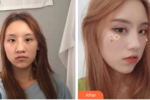 長(zhǎng)春韓一美容醫(yī)院張克善整形價(jià)格表附鼻部綜合案例展示