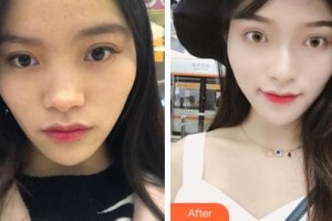 長(zhǎng)春韓一美容醫(yī)院金鐘皖整形價(jià)格表附耳軟骨復(fù)合隆鼻案例展示