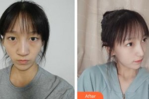 長(zhǎng)春海峽美容醫(yī)院孟憲勇整形價(jià)格表附耳軟骨復(fù)合隆鼻案例展示