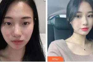 長(zhǎng)春正韓醫(yī)療美容醫(yī)院于俐媛整形價(jià)格表附切開雙眼皮案例展示