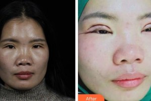 長(zhǎng)春正韓醫(yī)療美容醫(yī)院林偉卓整形價(jià)格表附切開雙眼皮案例展示