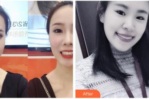 長(zhǎng)春海峽美容醫(yī)院孟慶思整形價(jià)格表附牙齒隱形矯正案例展示