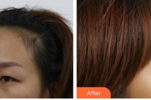 長(zhǎng)春愛麗醫(yī)療美容門診部金詠晙整形價(jià)格表附上眼瞼去脂案例展示