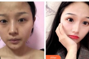 長(zhǎng)春圣華抗衰老醫(yī)學(xué)研究院肖大謙整形價(jià)格表附眼部綜合案例展示