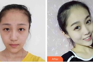 長(zhǎng)春姜醫(yī)生醫(yī)療美容診所姜廣霞整形價(jià)格表附切開雙眼皮案例展示