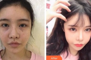 長(zhǎng)春韓合愛心美容醫(yī)院孫琦整形價(jià)格表附眼部綜合案例展示